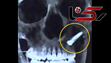 خارج کردن میخ 2.5 سانتی از صورت یک مرد+عکس