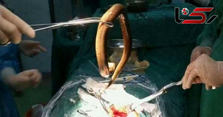  مارماهی 30 سانتی‌از شکم بیمار خارج شد ! +عکس 