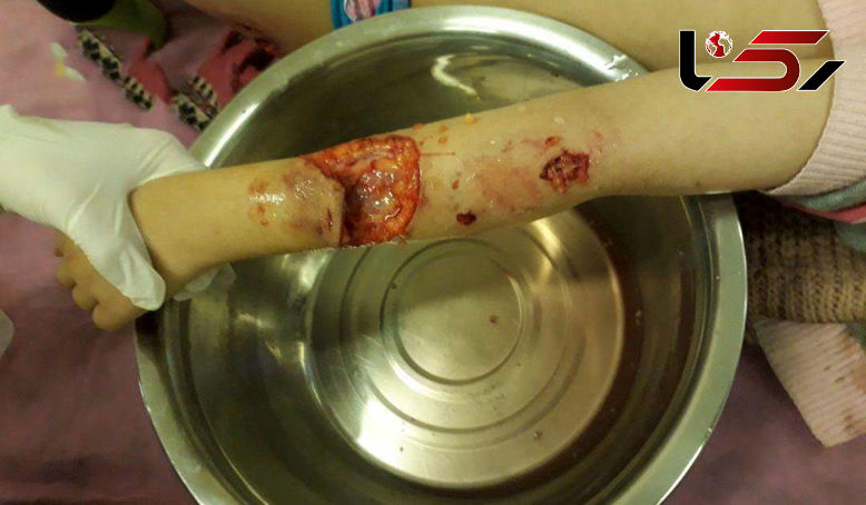 حمله خونین سگ ولگرد به کودک کرجی / یک محکومیت عجیب + جزییات