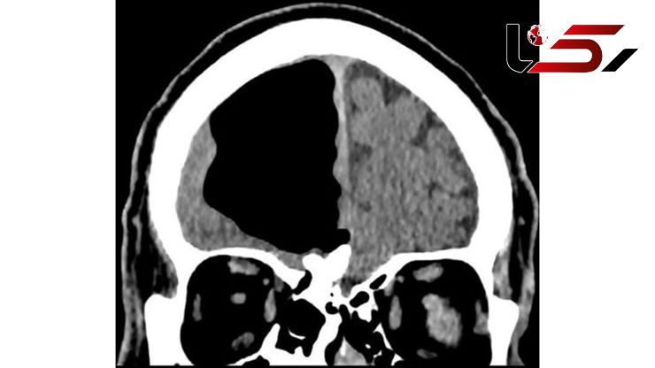 نصف جمجمه این مرد به جای مغز هوا است! / او هیچ مشکلی ندارد + عکس عجیب
