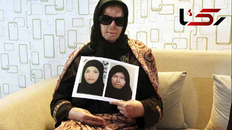 عکس قبل و بعد از اسیدپاشی به چهره زنی در بم + جزییات تکاندهنده